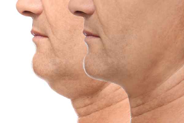 HIFU - Breakthrough in Anti - ageing 2 hifu results Hillingdon